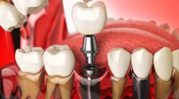 Does dental implant surgery hurt?
