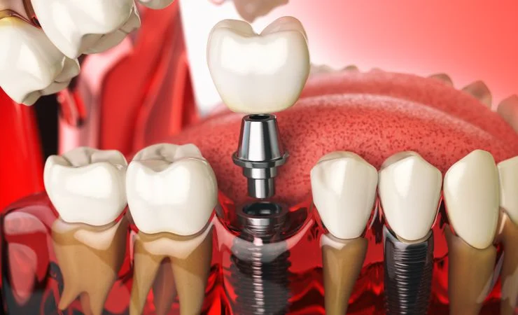 Does dental implant surgery hurt?