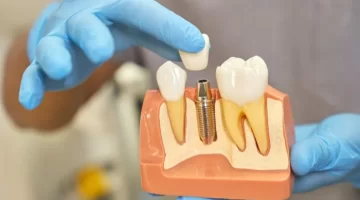 How long does dental implant surgery take?