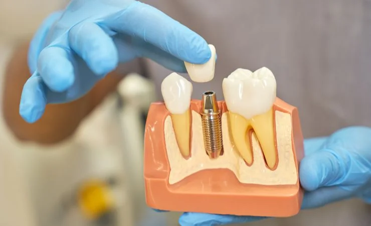 How long does dental implant surgery take?