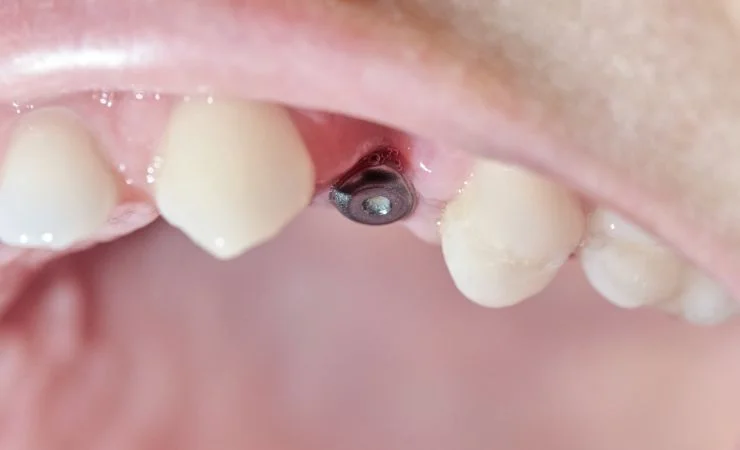 What are dental implants and their benefits?