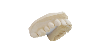 Custom dentures