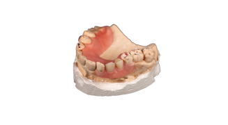 Immediate dentures
