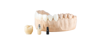 Implant supported dentures