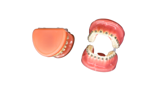 Overdentures