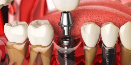 dental implant bridge 544x239